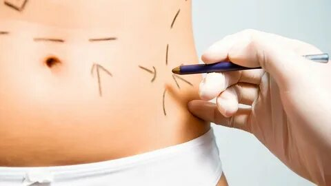 Best Tubeless Tummy Tuck New York – Expert No-Drain Surgery